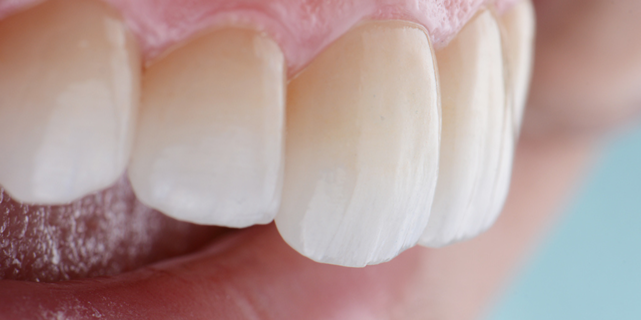 Los beneficios del feldespato dental en las coronas Chairside